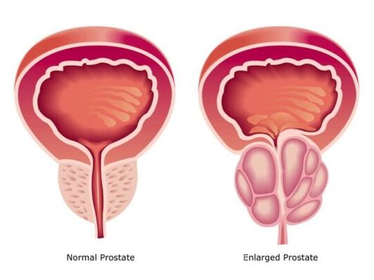 Normal and expanded prostate